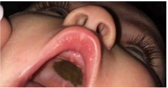 She quickly left and headed to the hospital after noticing a black spot in her daughter’s mouth.