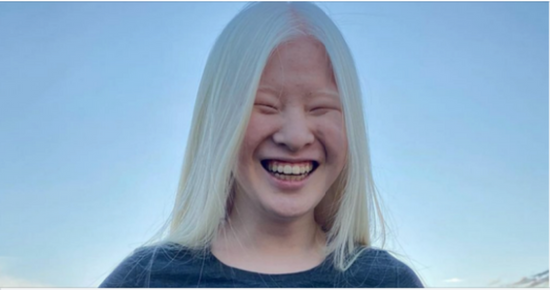 Girl Abandoned By Parents For Her Looks Wants To Prove The World Wrong – Now She Models For Vogue