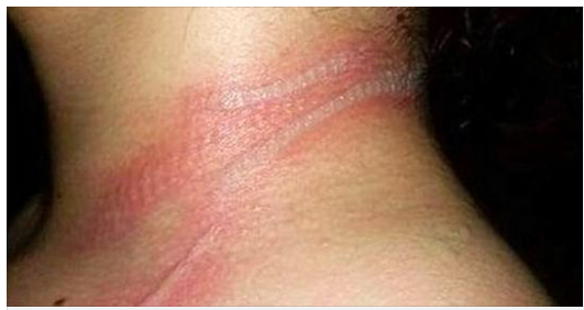 The child, only 13 years old, had terrible marks on her neck
