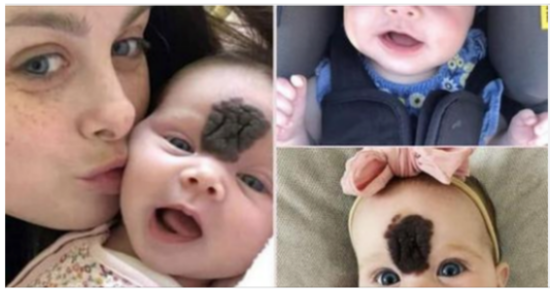 Parents chose to keep their baby out of the public eye to protect her from prying stares. Now, at the age of two, she blossoms into a beautiful child.