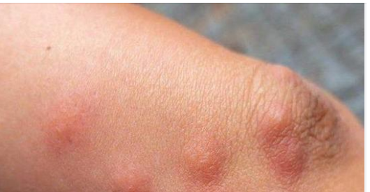 Trick To Stop Mosquito Bite From Itching 