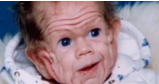 In 1993, This Boy Was Born With Enough Skin For A Five-Year-Old. But Wait Till You See Him Today