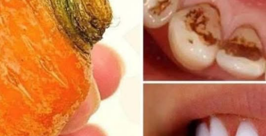 Say Goodbye to Yellowing Teeth