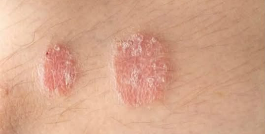 Five Psoriasis Warning Signs You Must Not Ignore 